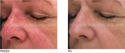 maska terapeutyczna pca skin kosmetyczka jarocin